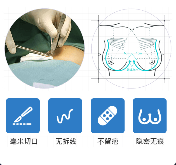 上海美莱医院假体丰胸方法有哪些