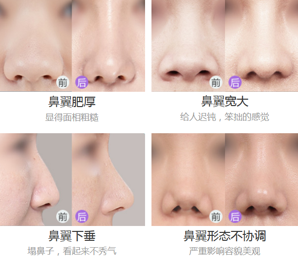 上海美莱垫鼻子需要多少钱
