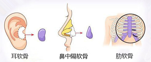 为什么要选择耳软骨隆鼻