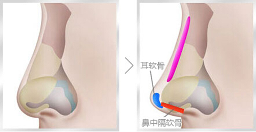 为什么要选择耳软骨隆鼻