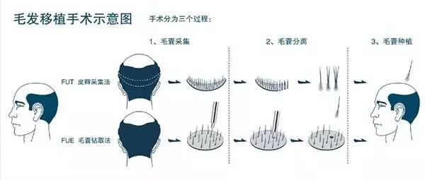 美莱毛发移植_宛若天生的感觉！