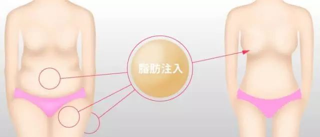 上海隆胸有哪几种方式？自己到底适合哪种