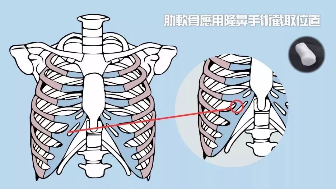 自体软骨隆鼻会不会对身体造成危害