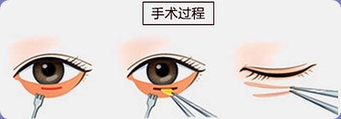 上海开眼袋手术做的好不好，术后怎么护理