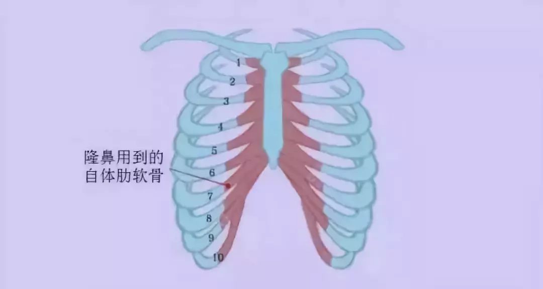 上海肋软骨隆鼻的手术方法，了解一下！