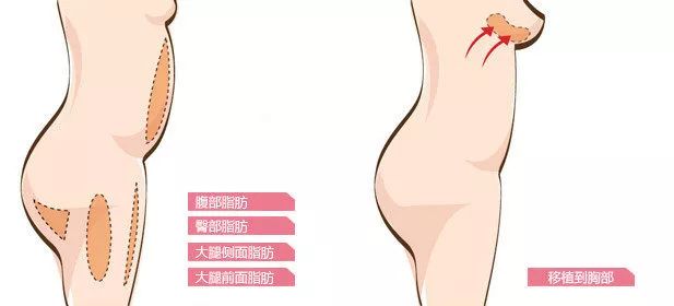 上海美莱脂肪移植，吸脂塑形，打造身体曲线！