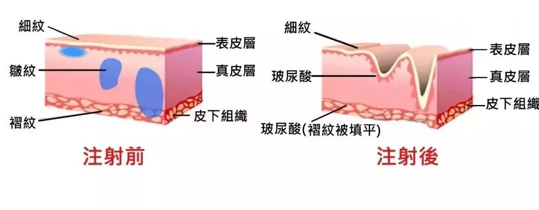 上海美莱*雕+玻尿酸威力有多大？年轻二十岁不是梦！