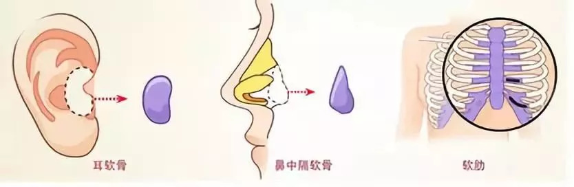 上海美莱肋软骨隆鼻|专人定制，缔造经典美鼻！