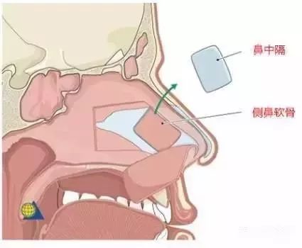上海做达拉斯隆鼻整形手术的价格是多少