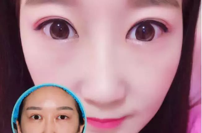 杜医生双眼皮修复案例