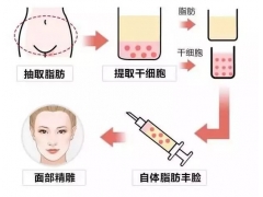 美莱揭晓：自体脂肪需要做二次填充吗