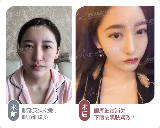 上海美莱祛眼袋案例