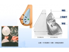 假体隆胸上海美莱真实可靠吗