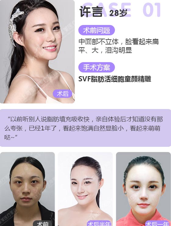 上海美莱SVF脂肪活细胞童颜精雕案例