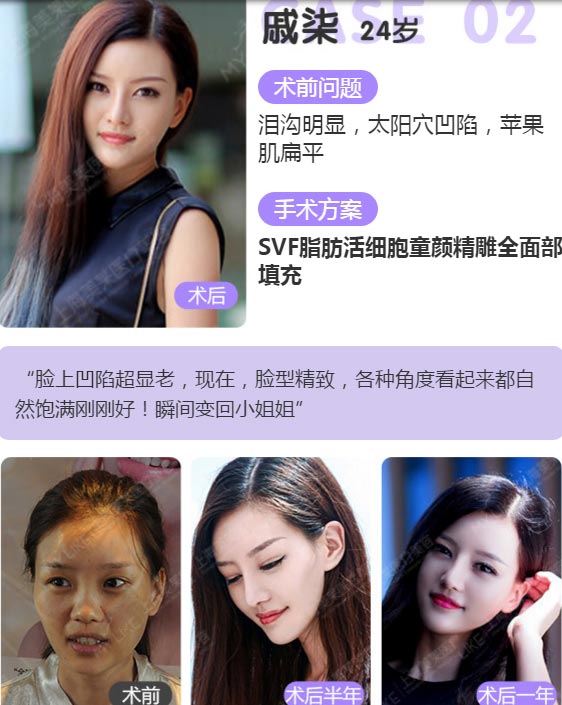 上海美莱SVF脂肪活细胞童颜精雕案例