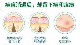 美莱介绍痘印形成的原因有哪些