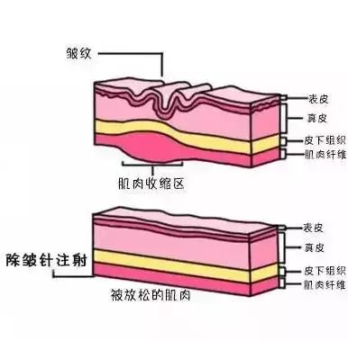 美莱去颈纹怎么样