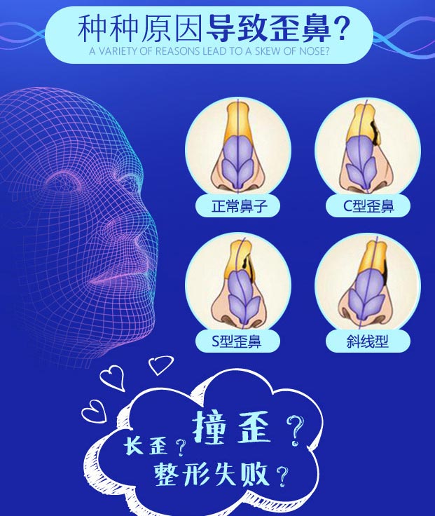 上海隆鼻手术歪鼻矫正美莱好不好