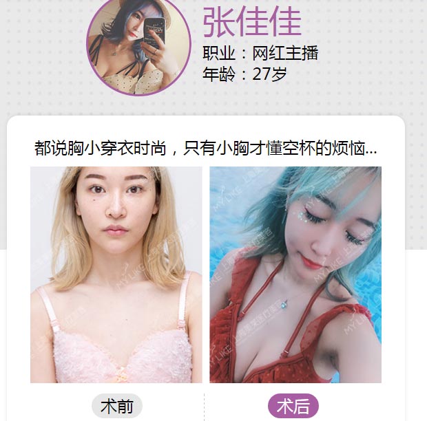 上海美莱假体丰胸案例