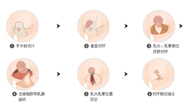 上海美莱乳房缩小术怎么样