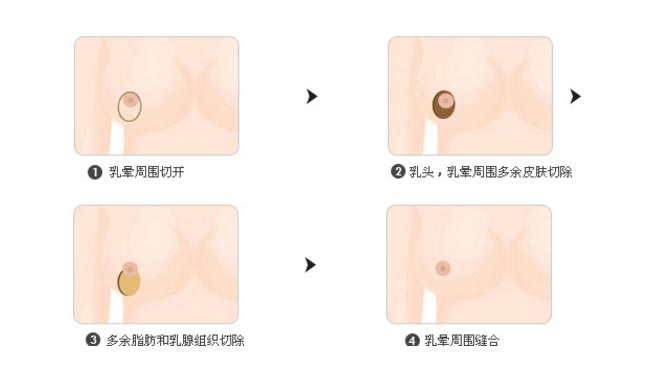 上海美莱乳房缩小术怎么样