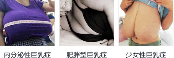 <a href='/' target='_blank'><u>上海美莱</u></a>乳房缩小术怎么样