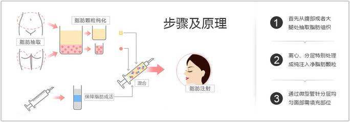 上海自体脂肪填充填充眼窝好不好