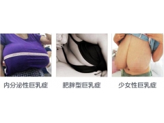 上海美莱乳房缩小术怎么样