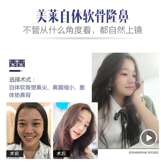 自体软骨隆鼻美莱案例图