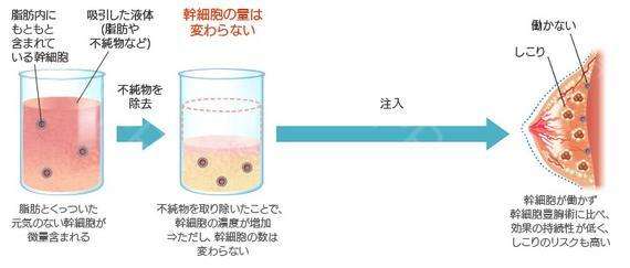 自体隆胸手术失败修复上海哪家医院做的好