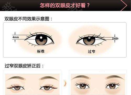 上海美莱双眼皮加开眼角多少钱