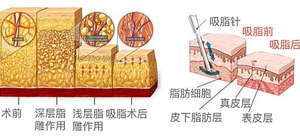 美莱怎样减肥大腿