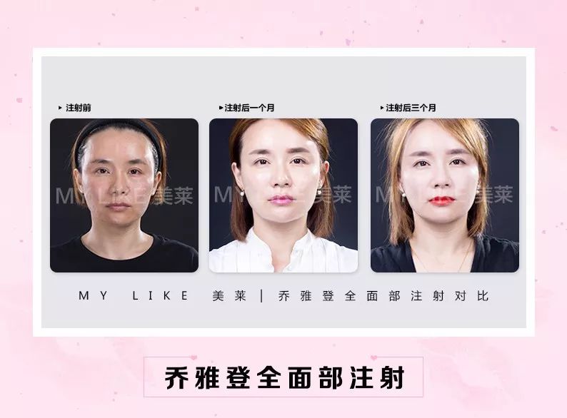 美莱乔雅登玻尿酸为什么能俘获众人芳心