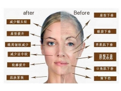 上海美莱做线雕怎么样