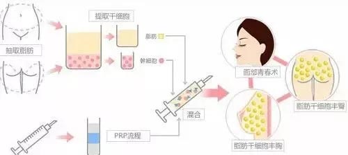 上海美莱自体脂肪填充双11狂欢