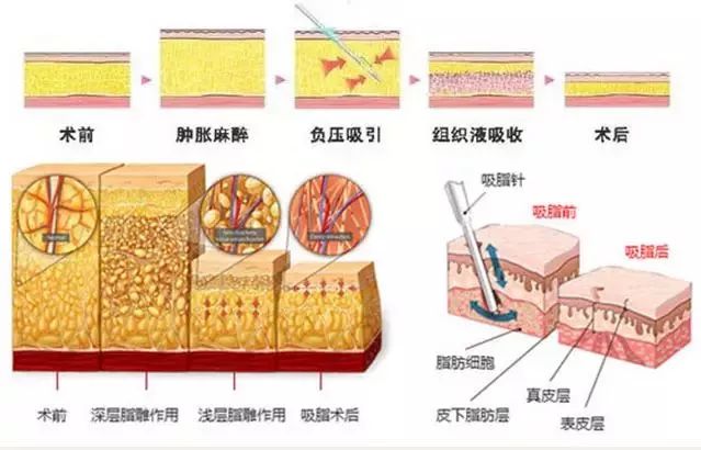 美莱减大肚腩赘肉简单方法