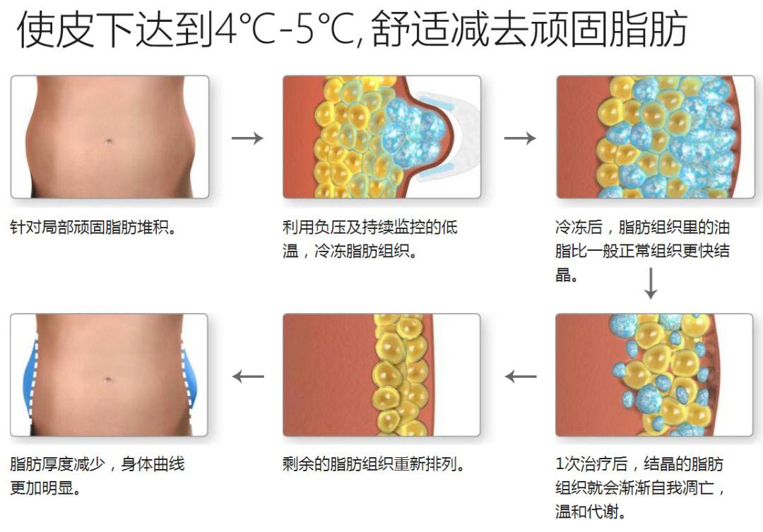 美莱瘦身"酷塑"—风靡全*之冷冻减脂技术