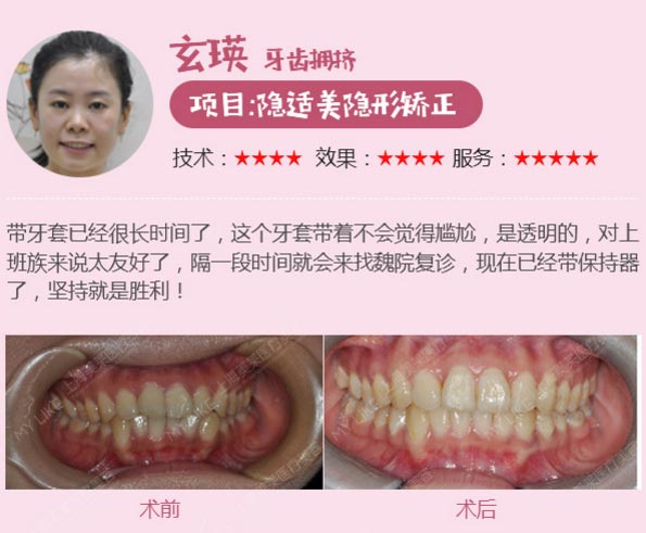 上海美莱牙齿矫正案例