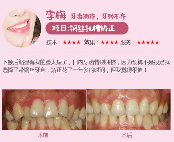 上海美莱牙齿矫正案例