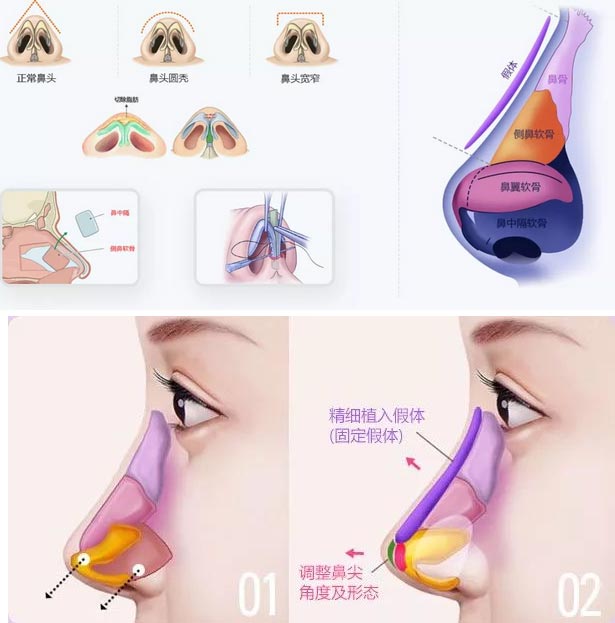 上海美莱告诉你：隆鼻哪样更好看