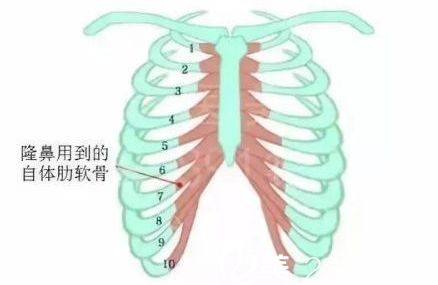 上海做肋骨隆鼻术多少钱