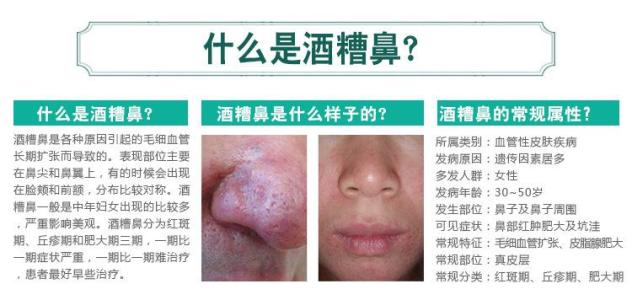 酒糟鼻怎么治疗上海美莱