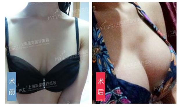 上海美莱胸部下垂矫正案例