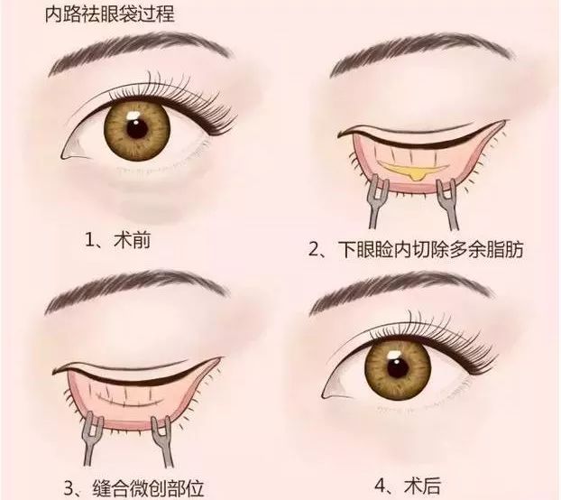 上海美莱眼部整形各方面塑造您靓亮之美