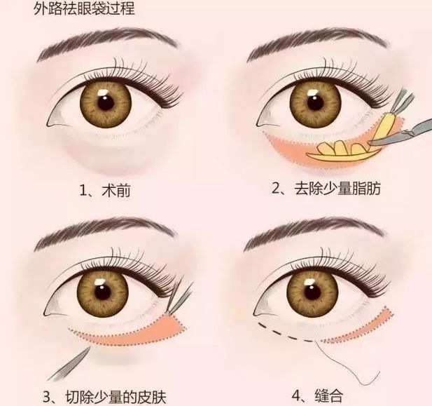 上海美莱眼部整形各方面塑造您靓亮之美