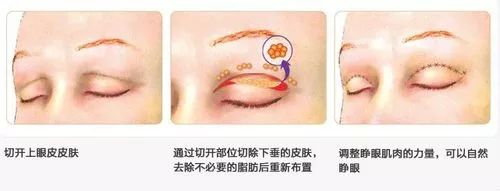 上海美莱眼部整形各方面塑造您靓亮之美