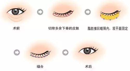 上海美莱眼部整形各方面塑造您靓亮之美