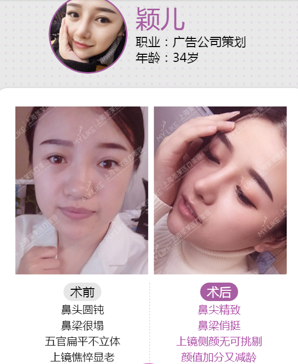 美莱真人隆鼻案例