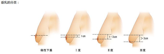 胸部下垂可以怎么提升美莱