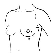 假体隆胸和脂肪隆胸哪个好